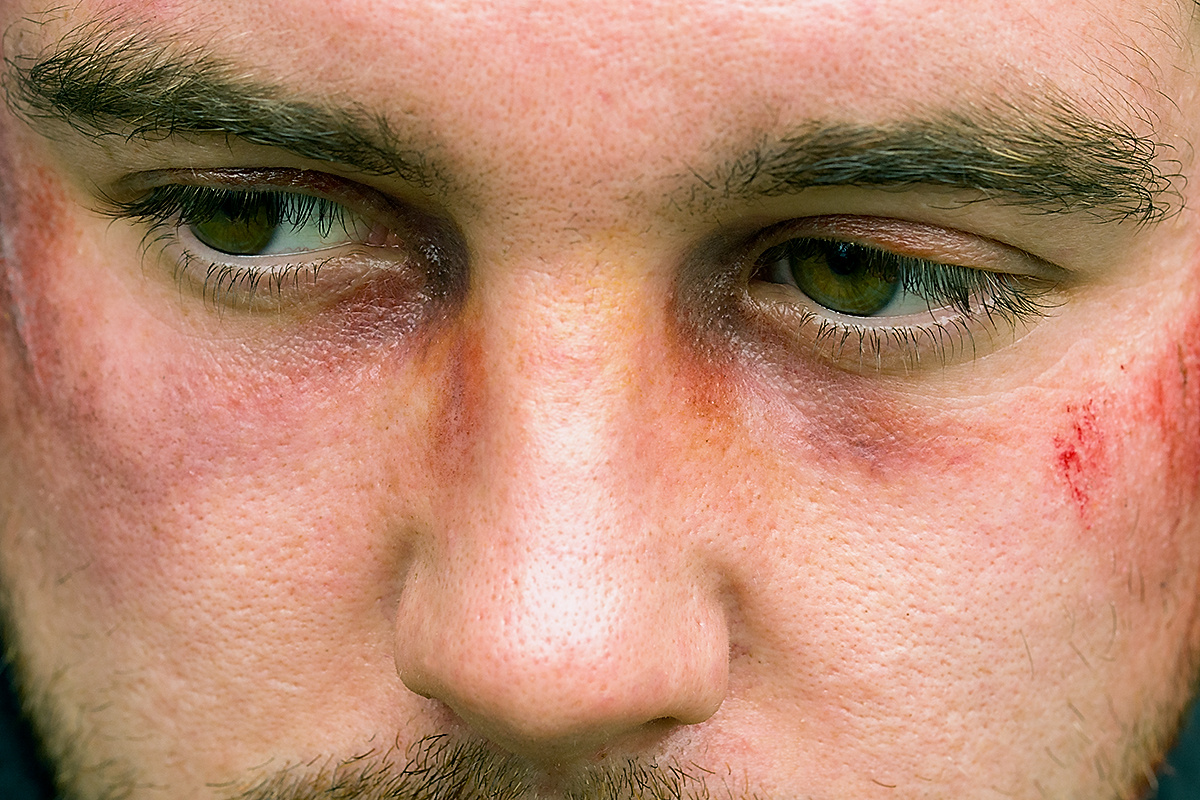 Close-up photograph showcasing special effects makeup depicting facial injuries, including bruises and a black eye, created by makeup artist Anett Alexandra Bulano.