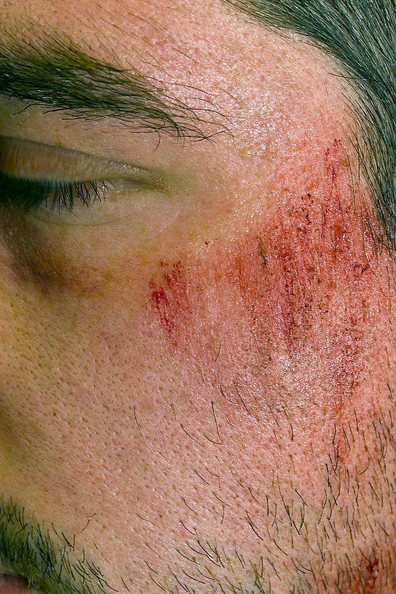 Close-up of special effects make-up showing facial injuries, including bruises and a black eye. Created by make-up artist Anett Alexandra Bulano.